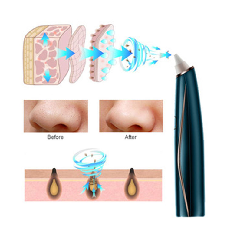 Pore ​​Acne Cleansing Electric Blackhead Remover ၊